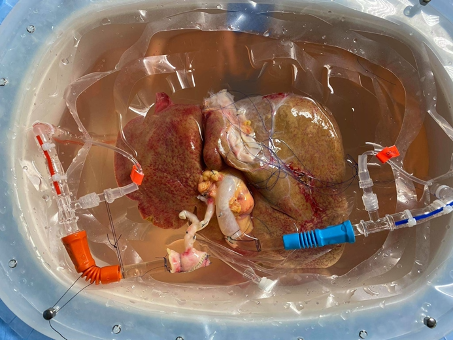 fotografia wątroby przygotowywanej do transplantacji w trakcie perfuzji D-HOPE, 8 lipca 2020
