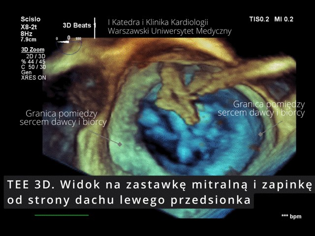Pierwszy w Polsce zabieg przezskórnego leczenia ciężkiej niedomykalności mitralnej (TEER-MR) u chorego po przeszczepie serca