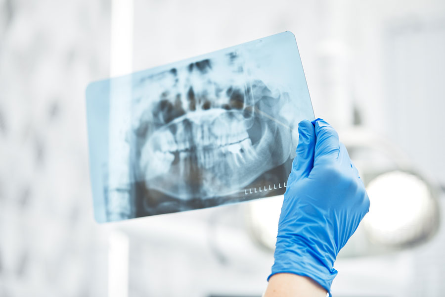 Radiograph of the jaw held by a hand in a blue glove