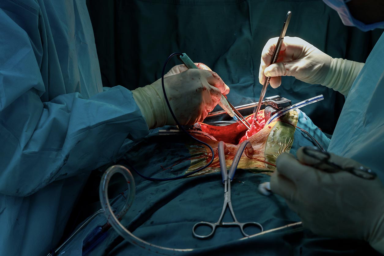 Zespół medyczny w trakcie operacji. Osoby na zdjęciu ubrane są w niebieskie fartuchy medyczne, operują nad stołem, widać narzędzia chirurgiczne.