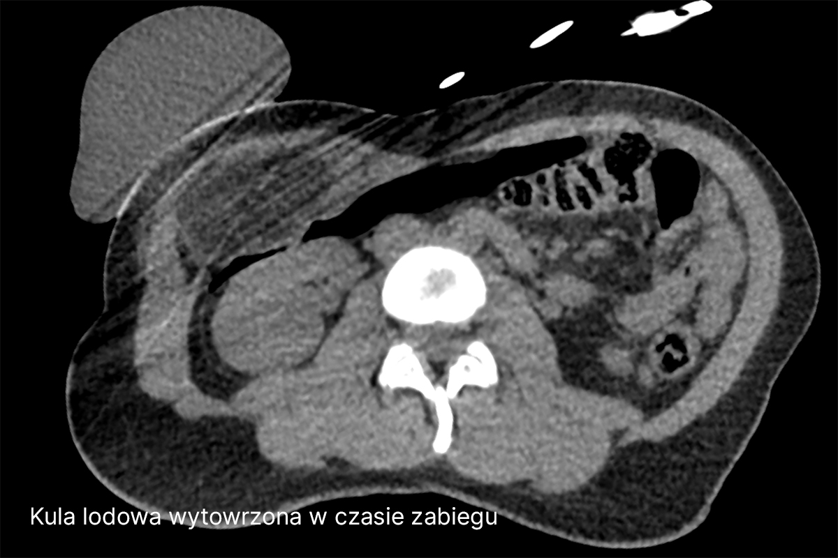 Przekrój osiowy tomografii komputerowej jamy brzusznej. Widoczny trzon kręgu lędźwiowego, narządy jamy brzusznej oraz pętle jelitowe. W przedniej części jamy brzusznej widoczny jest obszar o odmiennej gęstości tkanek. Obraz ma charakter medyczny i przedstawia struktury anatomiczne w skali szarości. Zdjęcie jest podpisane "Kula lodowa wytworzona w czasie zabiegu".