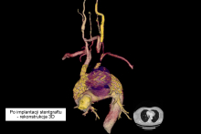 Po implantacji stentgraftu - rekonstrukcja 3D