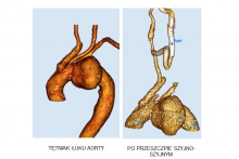 (1) Tetniak łuku aorty - rekonstrukcja 3D, (2) po przeszczepie szyjno-szyjnym -rekonstrukcja 3D