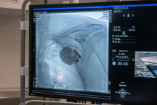 Zdjęcie ilustrujące zabieg implantacji kardiowertera-defibrylatora nowej generacji