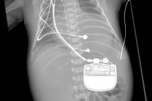 Ryc. 5. Rtg po implantacji układu stymulujacego