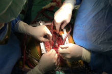 The First Simultaneous Heart-Liver Transplantation in Poland 