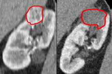 krioablacja_raka_nerki_przed_i_po.jpg – po stronie lewej widoczny jest guz, a po prawej - martwica w miejscu po zniszczonym guzie.