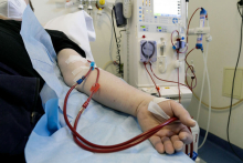 hemodialysis