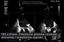 The first in Poland transcatheter procedure for severe mitral regurgitation (TEER-MR) in a heart transplant patient