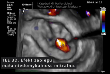 The first in Poland transcatheter procedure for severe mitral regurgitation (TEER-MR) in a heart transplant patient