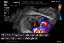 The first in Poland transcatheter procedure for severe mitral regurgitation (TEER-MR) in a heart transplant patient