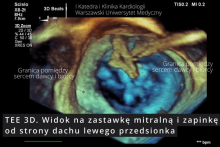 Pierwszy w Polsce zabieg przezskórnego leczenia ciężkiej niedomykalności mitralnej (TEER-MR) u chorego po przeszczepie serca