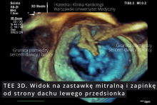 The first in Poland transcatheter procedure for severe mitral regurgitation (TEER-MR) in a heart transplant patient