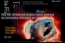 Pierwszy w Polsce zabieg przezskórnego leczenia ciężkiej niedomykalności mitralnej (TEER-MR) u chorego po przeszczepie serca