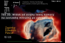 The first in Poland transcatheter procedure for severe mitral regurgitation (TEER-MR) in a heart transplant patient