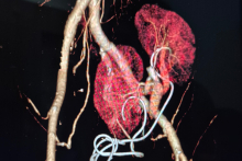 Reconstruction from computed tomography. It shows the kidneys and blood vessels, as well as vascular anastomoses.
