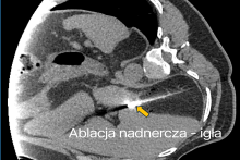 Przekrój TK podczas zabiegu ablacji. Widoczna igła wprowadzona do nadnercza, której końcówka znajduje się w obrębie zmiany. Strzałka wskazuje narzędzie.