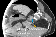 Przekrój TK po zabiegu ablacji nadnercza. Strzałki wskazują miejsce po leczeniu oraz zmieniony obszar w obrębie nadnercza. Widoczne są struktury jamy brzusznej i naczynia.