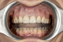 Close-up of the oral cavity during a dental examination using a metal retractor; the upper and lower teeth and a clear aligner on the lower dental arch are visible.
