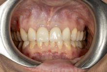 Close-up of the oral cavity during a dental examination using a metal retractor; the upper and lower dental arches are visible.