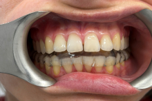 Close-up of the oral cavity with a metal retractor; a clear aligner is fitted over the lower dental arch, while the upper teeth remain exposed.