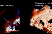 Mitraclip Fotorealistyczne obrazowanie.png