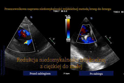 Successful treatments of transcatheter valve regurgitation using the edge-to-shore method