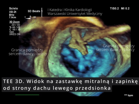 Pierwszy w Polsce zabieg przezskórnego leczenia ciężkiej niedomykalności mitralnej (TEER-MR) u chorego po przeszczepie serca