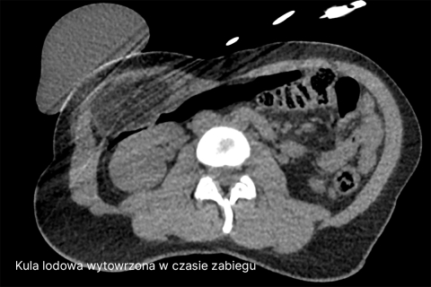 Przekrój osiowy tomografii komputerowej jamy brzusznej. Widoczny trzon kręgu lędźwiowego, narządy jamy brzusznej oraz pętle jelitowe. W przedniej części jamy brzusznej widoczny jest obszar o odmiennej gęstości tkanek. Obraz ma charakter medyczny i przedstawia struktury anatomiczne w skali szarości. Zdjęcie jest podpisane "Kula lodowa wytworzona w czasie zabiegu".
